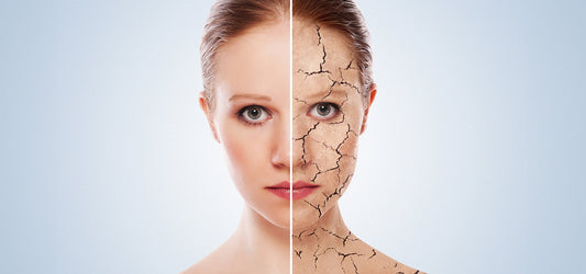 Trockene Haut im Winter