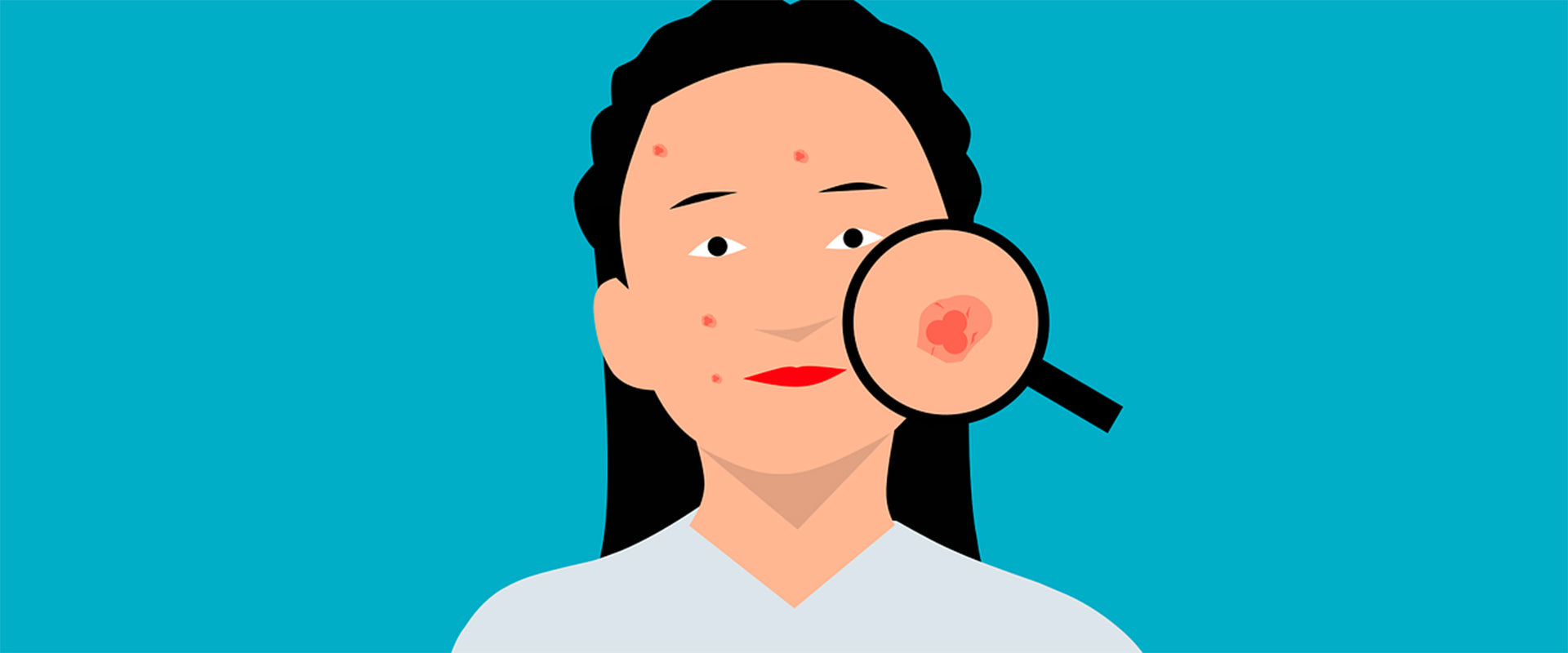 Akne – Überblick und Hautareale mit vielen Talgdrüsen