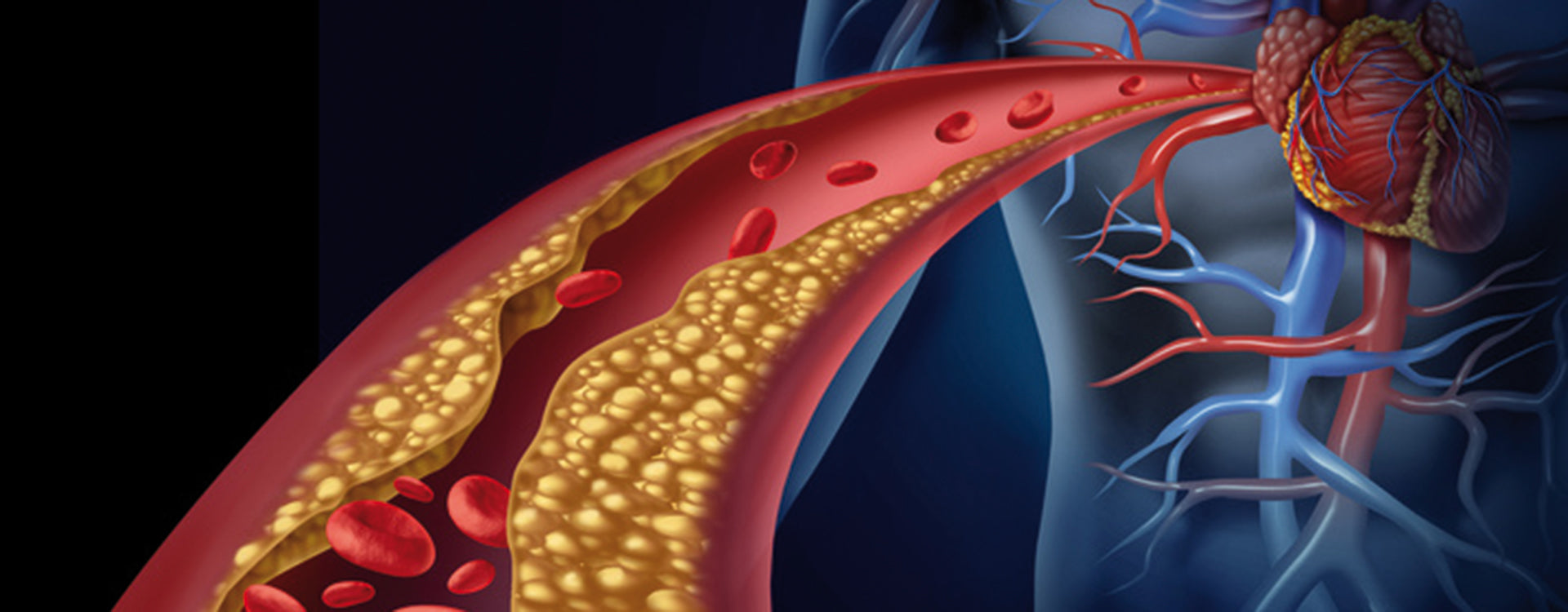 Arteriosklerose – Entstehung und Risikofaktoren